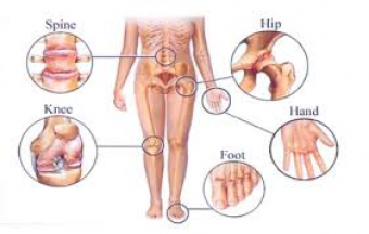 How Physiotherapy Can Help With Arthritis & Pain Relief