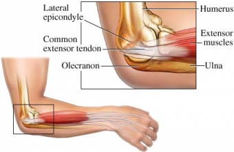 Fast Facts About Tennis Elbow (a.k.a lateral epicondylalgia)