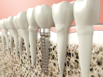 How Many Dental Implants Can I Get?