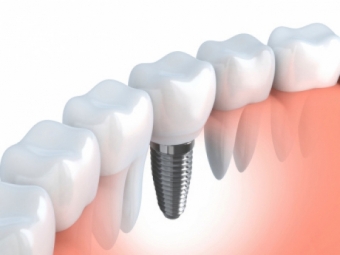 The Parts of a Dental Implant
