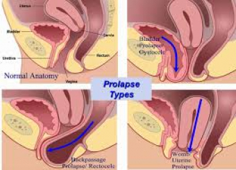 Organ Prolapse
