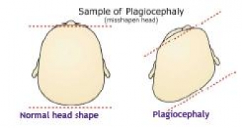 Infant Torticollis (& Plagiocephaly)