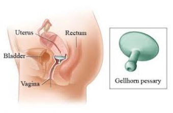 Pelvic Organ Prolapse & Pessary 101