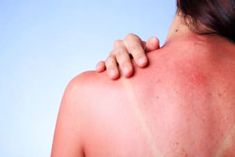 Can I get a massage if I have a sunburn?