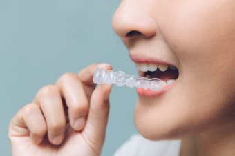 How Does Invisalign® Work?