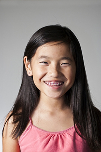 What are Fastbraces®?