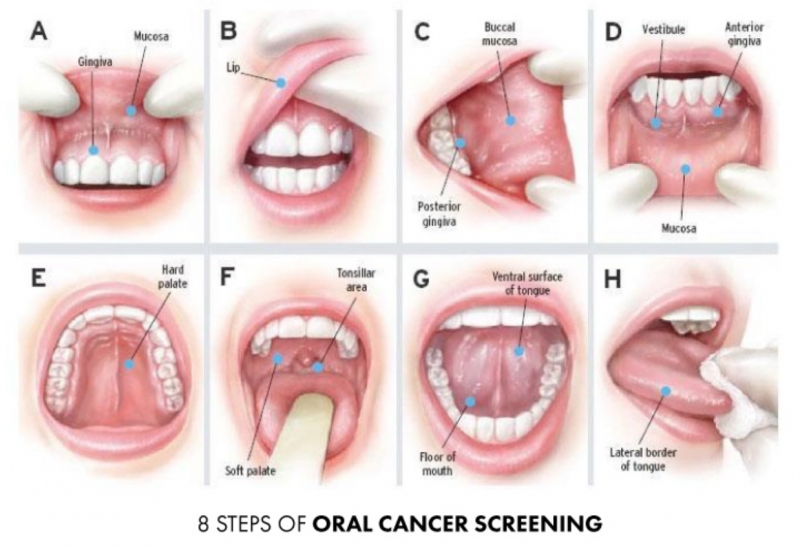 Dental Oral Cancer Examination in Maple Ridge