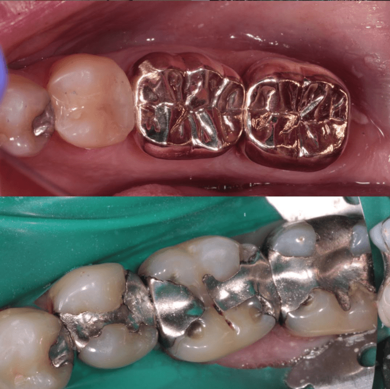 The 5 things you do not know about silver fillings (Amalgam Restorations)
