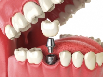  The Parts of a Dental Implant