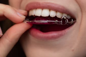 What Is Orthodontic Relapse?: Teeth Shifting After Braces