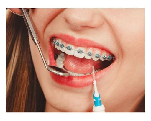 Why You Should Still Visit Your Dentist During Orthodontic Treatment