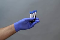 What Happens if Your TB Test Is Positive for Immigration in Canada?