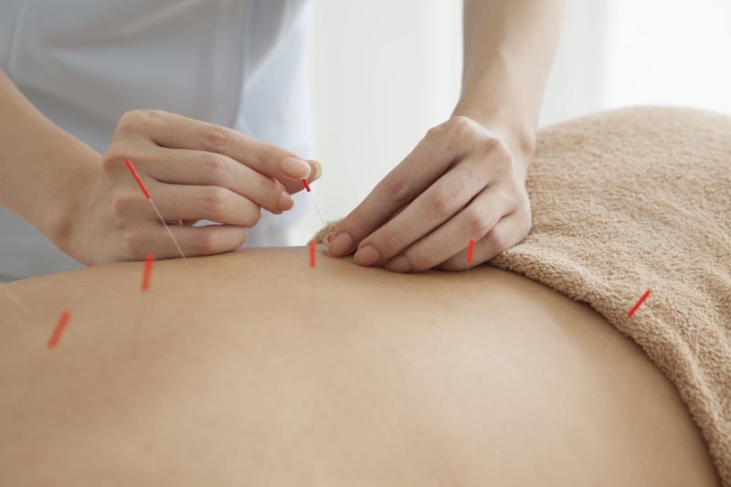 The Benefits of Traditional Chinese Medicine and Acupuncture
