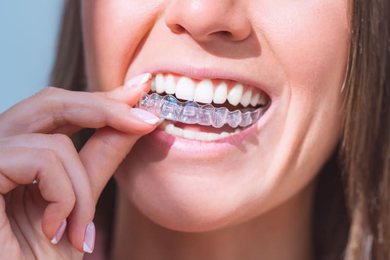 Straight Talk: 5 Things to Know About Invisalign® Aligners