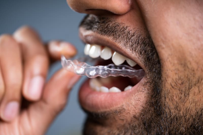 Statistics on Adult Orthodontics: Who is Getting Braces and Why?