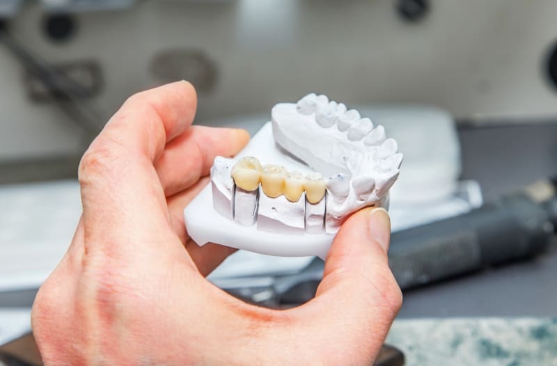 Steps To Compare Bridges For Tooth Replacement In Maple Ridge