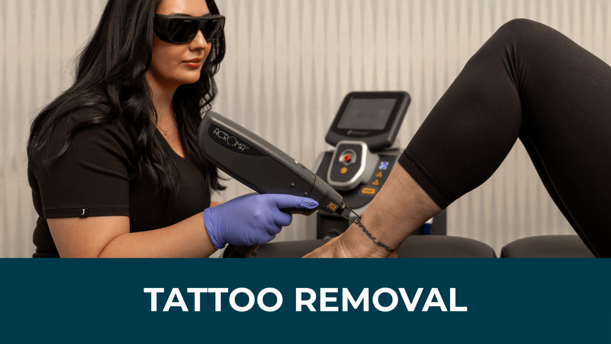 February: Tattoo Removal (including Brow Tattoo) Removal Promotion