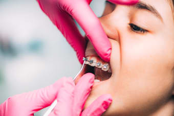 How Often Do You Get Your Braces Tightened or Adjusted?