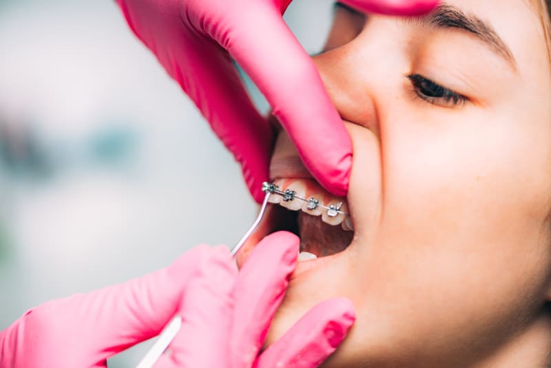 How Often Do You Get Your Braces Tightened or Adjusted?
