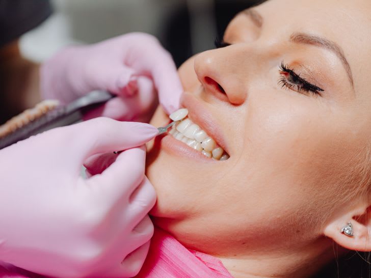 How Much Is a Full Set of Veneers?