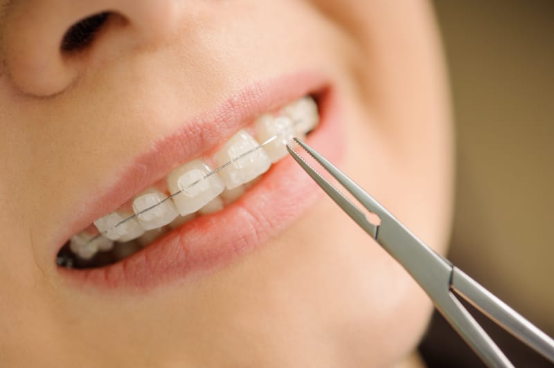 How Translucent Cosmetic Braces Improve Teeth Aesthetics
