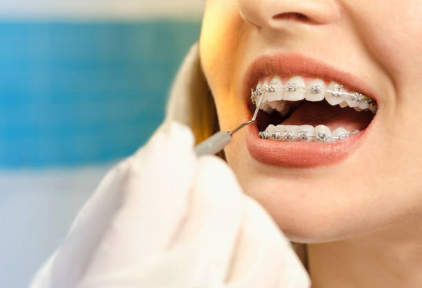 Choosing an Orthodontist in Langley BC for Braces and Invisalign: A Starting Guide in 2026