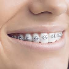 Types of Braces in 2026: Metal, Ceramic, and Clear Options Compared