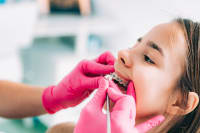 How to Keep Your Braces Clean At Home