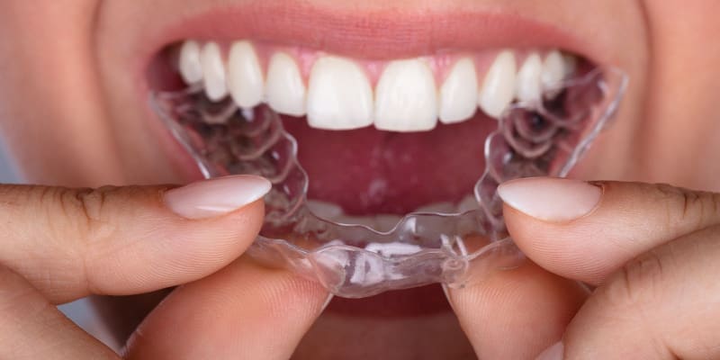 How Long Invisalign Actually Takes for Adults: Setting Real Expectations