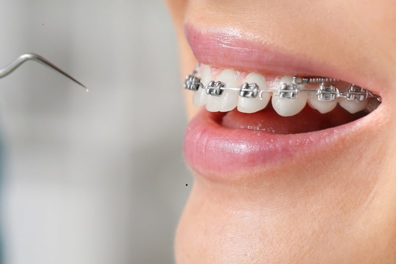 Picking an Orthodontist for Your Teenager: A Parent's Practical Guide in 2026