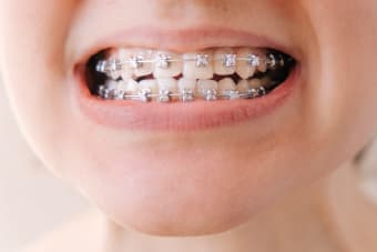 Finding an Orthodontist for Complex Bite Issues: A Patient's Overview