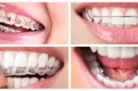 Types of Braces in 2026: Metal, Ceramic, and Clear Options Compared