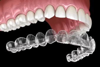 How Invisalign Works in 2026: The Treatment Process Explained