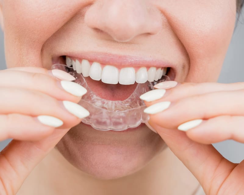 Can Invisalign Fix a Crossbite?