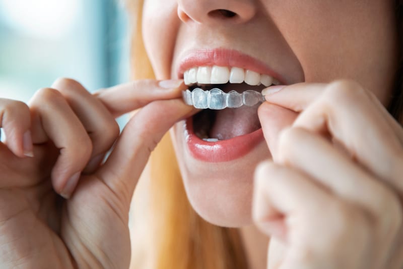 Retainers after Braces: Keeping Your Smile Straight