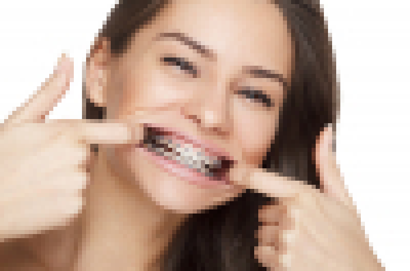 Talking With Braces Orthostyle Vancouver