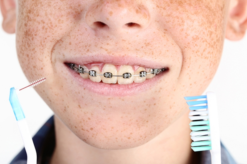 How do I brush my teeth with braces? Coquitlam Orthodontist