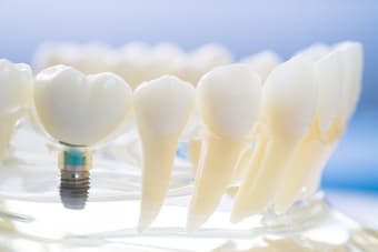 How long do dental implants take to heal?