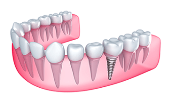 Reverse Your Tooth Loss with Dental Implants