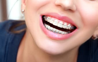 Braces vs. Clear Braces vs. Clear Aligners: Which treatment is right for me?