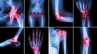 Understanding Arthritis