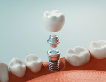 7 Questions to Ask Before a Dental Implant