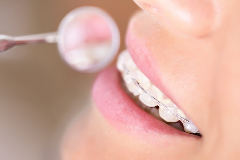 lingual braces vs translucent braces guildford orthodontic centre
